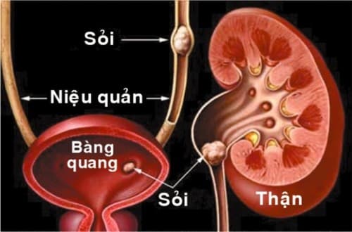 chữa sỏi bàng quang