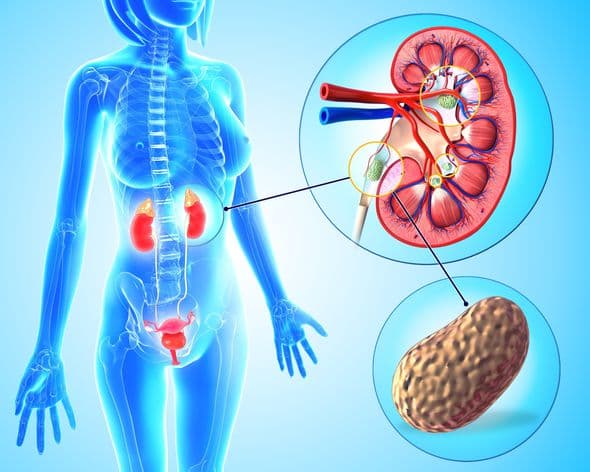 Tác hại của bệnh sỏi thận