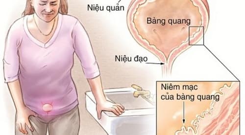 Thông tin về sỏi bàng quang