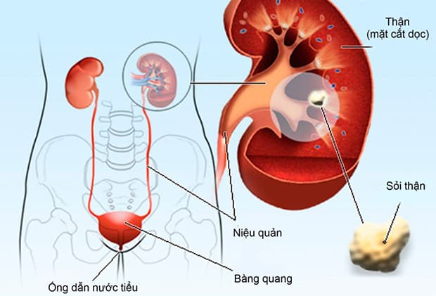 Biến chứng của bệnh sỏi niệu quản