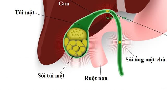 thông tin về sỏi mật