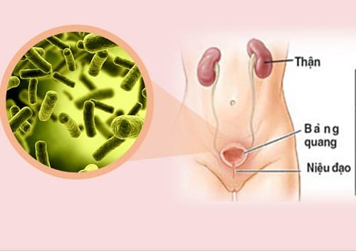 viêm bàng quang